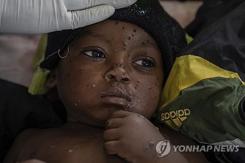 WHO, 엠폭스에 '최고 수준' 보건 경계태세 유지