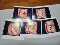 다섯쌍둥이 출산 부부, 1억 7천만원 넘게 지원받는다